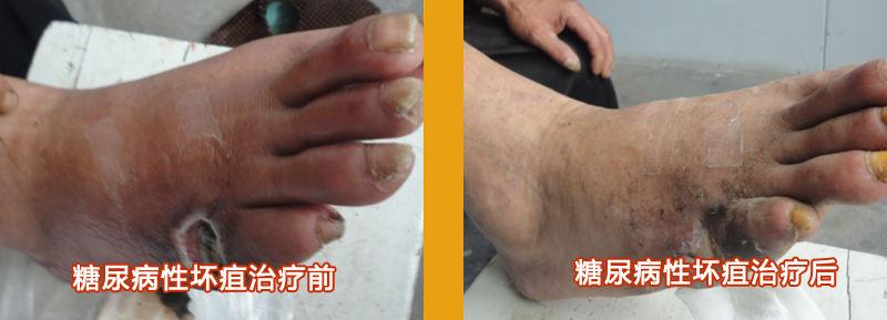 糖尿病性坏疽