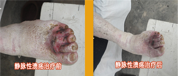 静脉性溃疡治疗